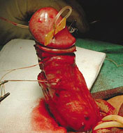 curved penis surgery curved penis surgery