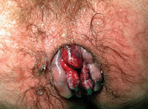severe hemorrhoid treatment