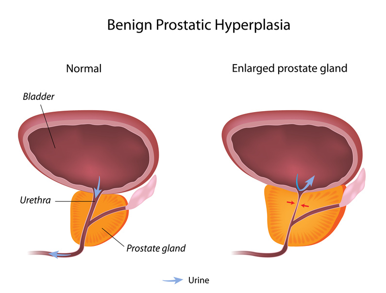 BPH caused by nutritional deficiency