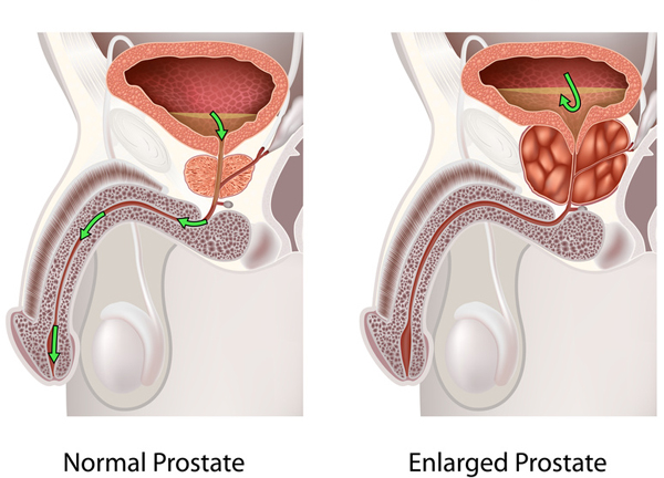 Advanced BPH restricts urine flow