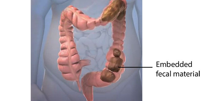 does colon cleansing work for prostatitis?
