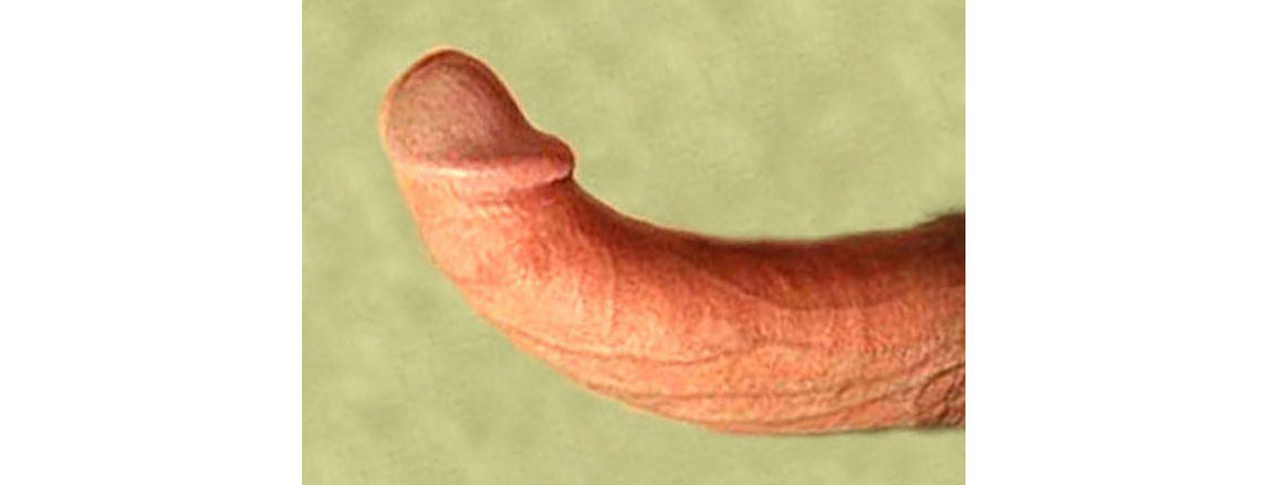 Increased Risk Of Cancer Among Men With A Curved Penis