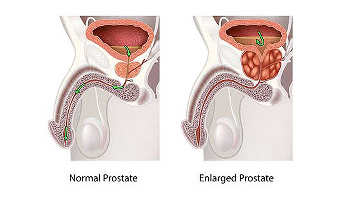natural treatment for enlarged prostate