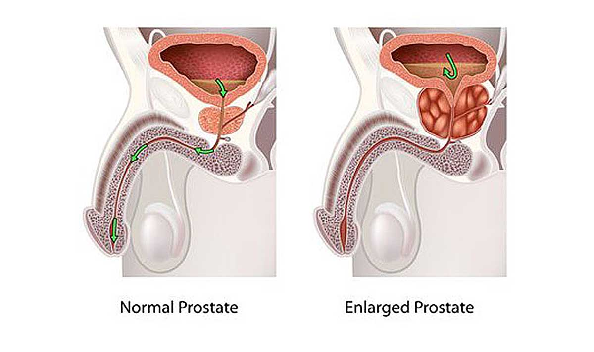 EnlargedProstate1200WEB
