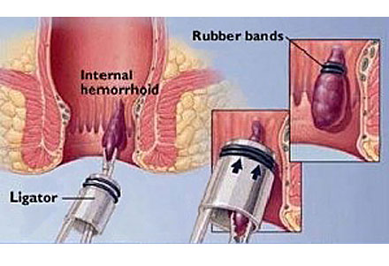 hemorrhoid banding