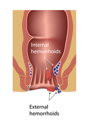 external and internal hemorrhoids