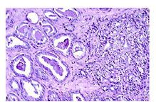 prostate specific antigen #1