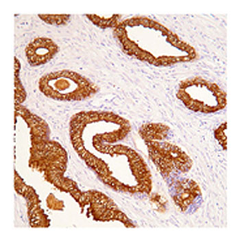 prostate specific antigen #3