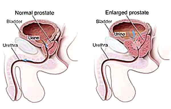enlarged prostate treatment diagram
