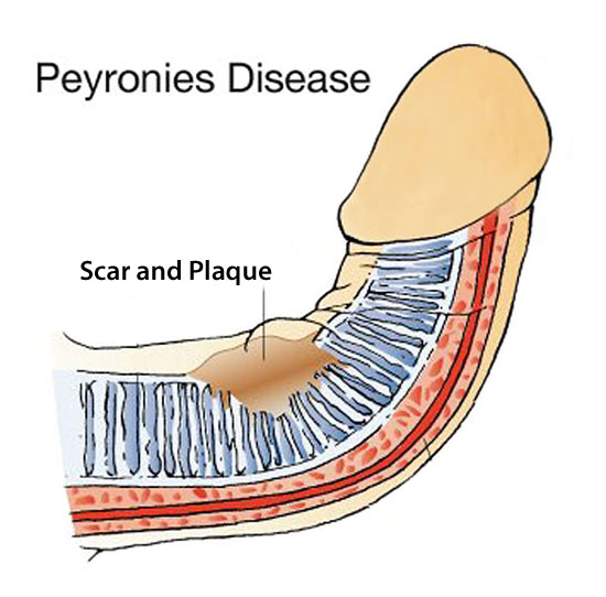 Peyronies Disease has one main cause. Scar and Plaque formations inside the shaft.