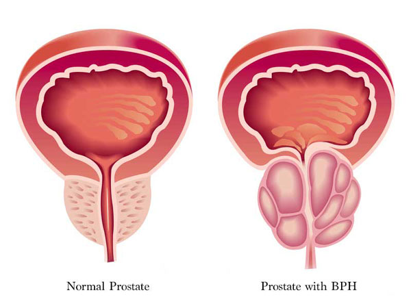 Normal and enlarged prostate