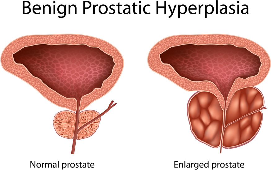 saw palmetto, BPH, and prostate health