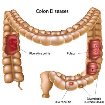 a good colon cleansing kit can help you aviod disease