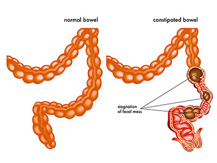 constipation problems and diseases