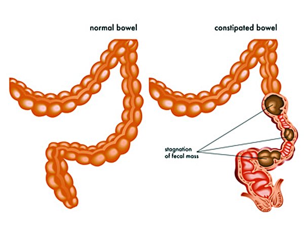 constipation and a normal bowel