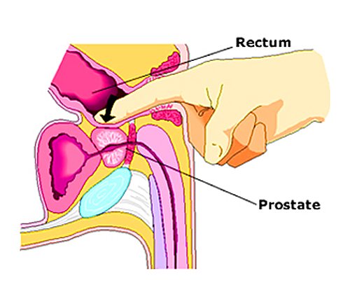 Herxheimer reaction from prostate massage