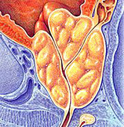 enlarged prostate treatment diagram