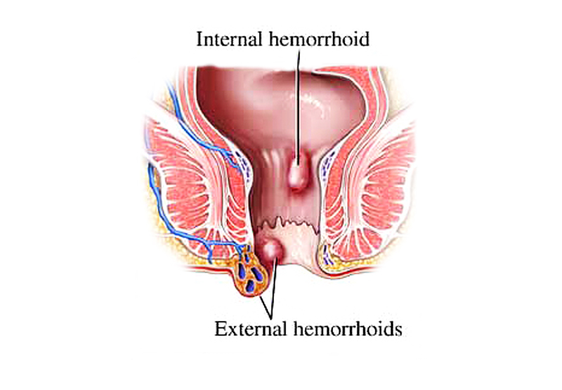 effective home treatment of hemorrhoids