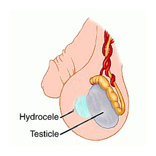 testicular exam hydrocele