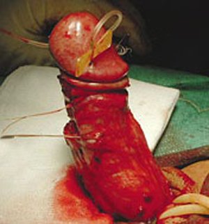 bent penis surgery