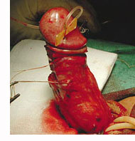 penis curvature treatment with surgery