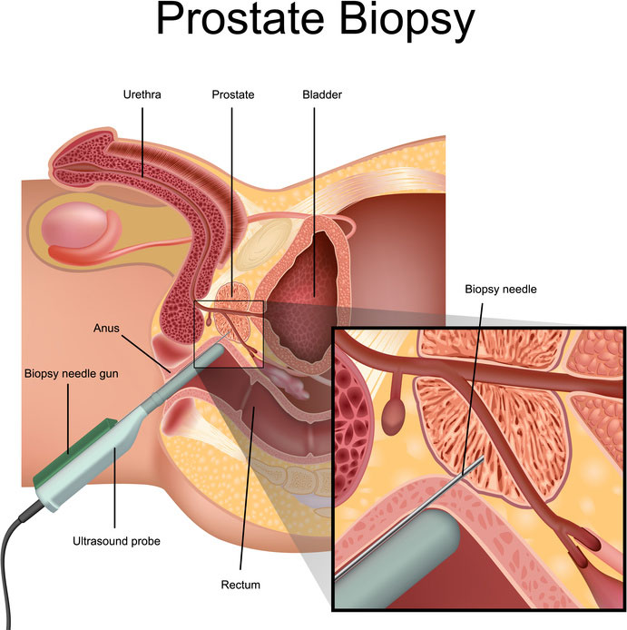 prostate biopsy and the prostate examination