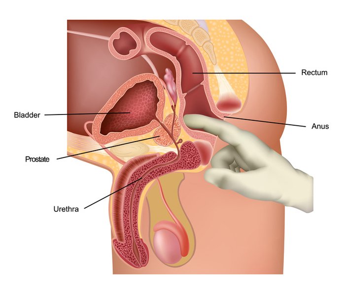 digital rectal exam and prostate milking