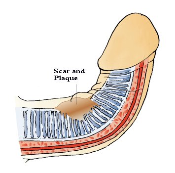 penis curvature caused by scar and/or plaque formation