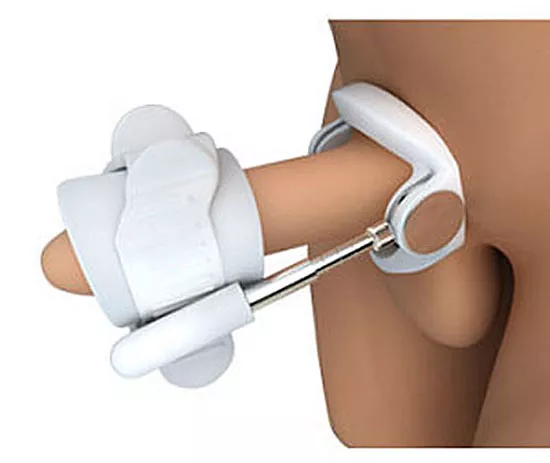 Penis Traction devices are the safest way to straighten a bent penis caused by Peyronies Disease.